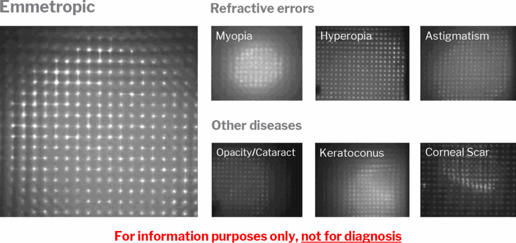 Examples of refractive conditions as seen in spot diagrams.